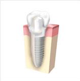 インプラント 歯